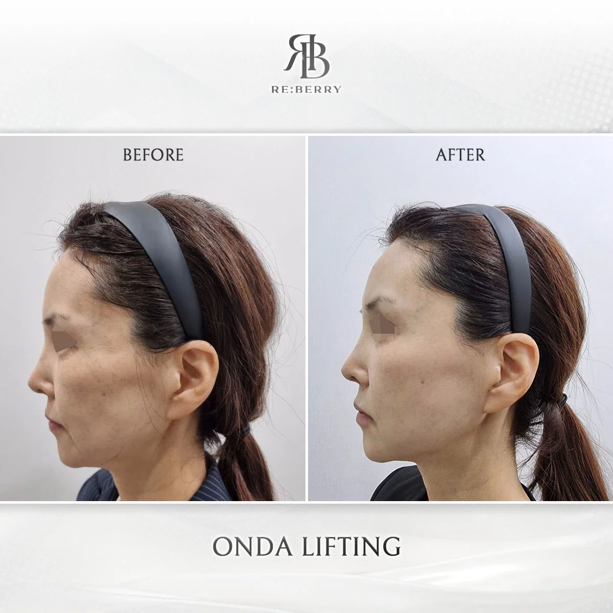 Non-surgical face lift result Seoul Korea